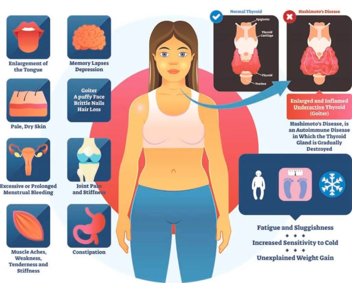 Diversi studi hanno evidenziato una frequente associazione della celiachia con alcune malattie autoimmuni anche della tiroide come la tiroidite di Hashimoto e il morbo di Basedow